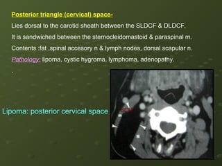 Sldcf Anatomy of neck for radiology seminars a | PPT