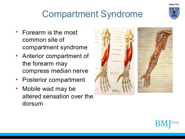 Upper Arm Compartment Syndrome - Acute Exertional Compartment Syndrome ...