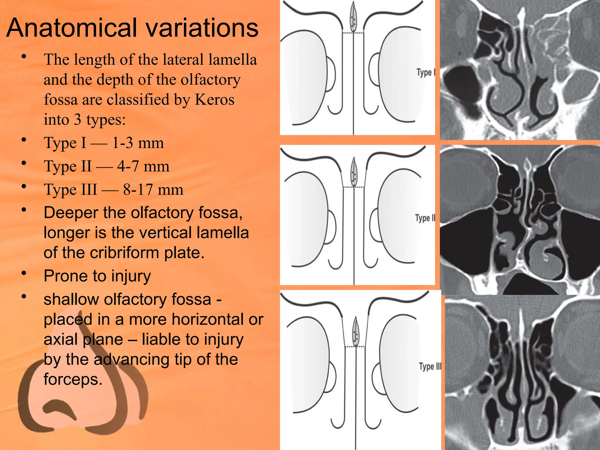 Anatomical variations
• The length of the lateral lamella
and the depth of the olfactory
fossa are classified by Keros
into 3 types:
• Type I — 1-3 mm
• Type II — 4-7 mm
• Type III — 8-17 mm
• Deeper the olfactory fossa,
longer is the vertical lamella
of the cribriform plate.
• Prone to injury
• shallow olfactory fossa -
placed in a more horizontal or
axial plane – liable to injury
by the advancing tip of the
forceps.
 