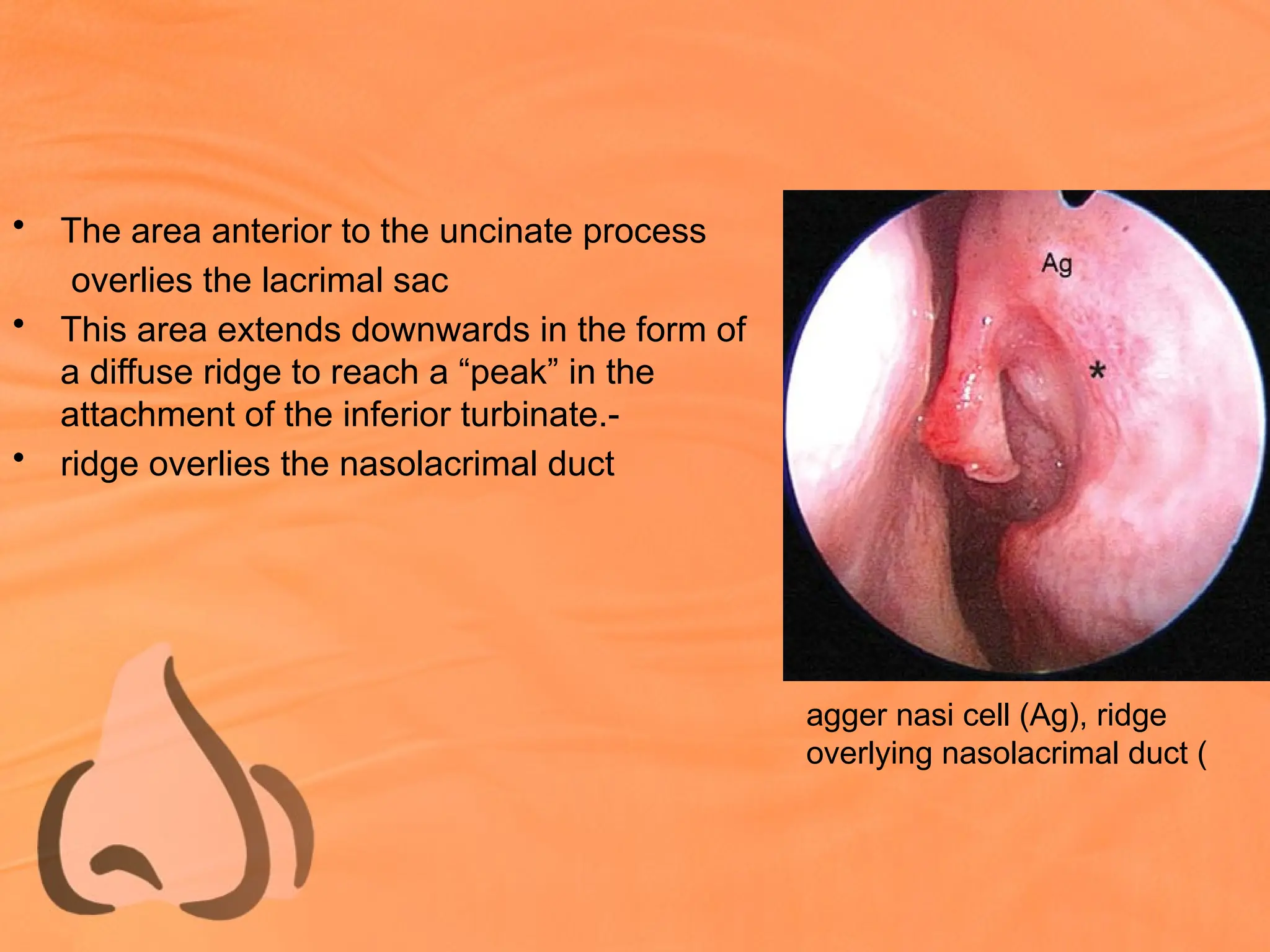 • The area anterior to the uncinate process
overlies the lacrimal sac
• This area extends downwards in the form of
a diffuse ridge to reach a “peak” in the
attachment of the inferior turbinate.-
• ridge overlies the nasolacrimal duct
agger nasi cell (Ag), ridge
overlying nasolacrimal duct (
 
