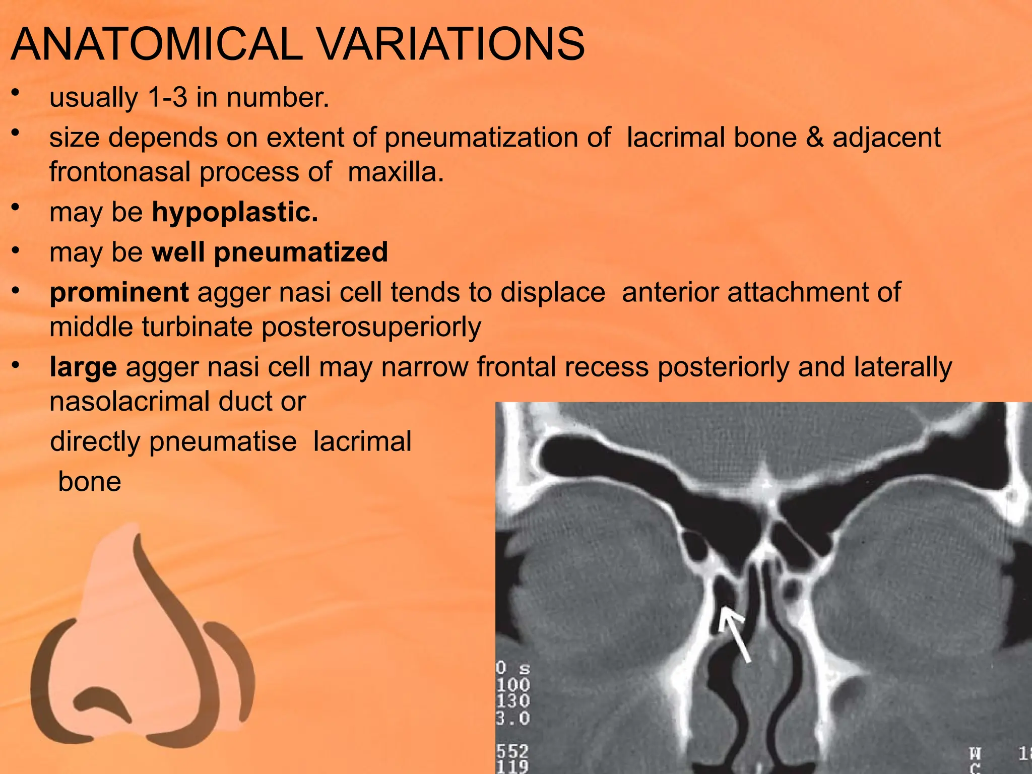 ANATOMICAL VARIATIONS
• usually 1-3 in number.
• size depends on extent of pneumatization of lacrimal bone & adjacent
frontonasal process of maxilla.
• may be hypoplastic.
• may be well pneumatized
• prominent agger nasi cell tends to displace anterior attachment of
middle turbinate posterosuperiorly
• large agger nasi cell may narrow frontal recess posteriorly and laterally
nasolacrimal duct or
directly pneumatise lacrimal
bone
 