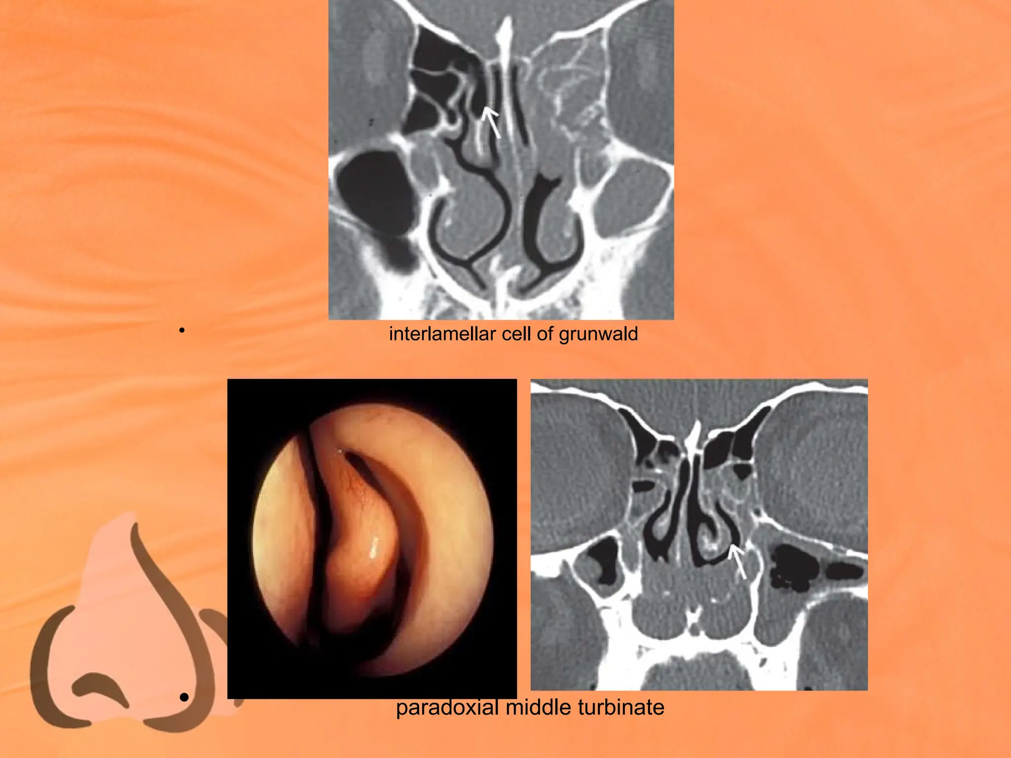 • interlamellar cell of grunwald
• paradoxial middle turbinate
 