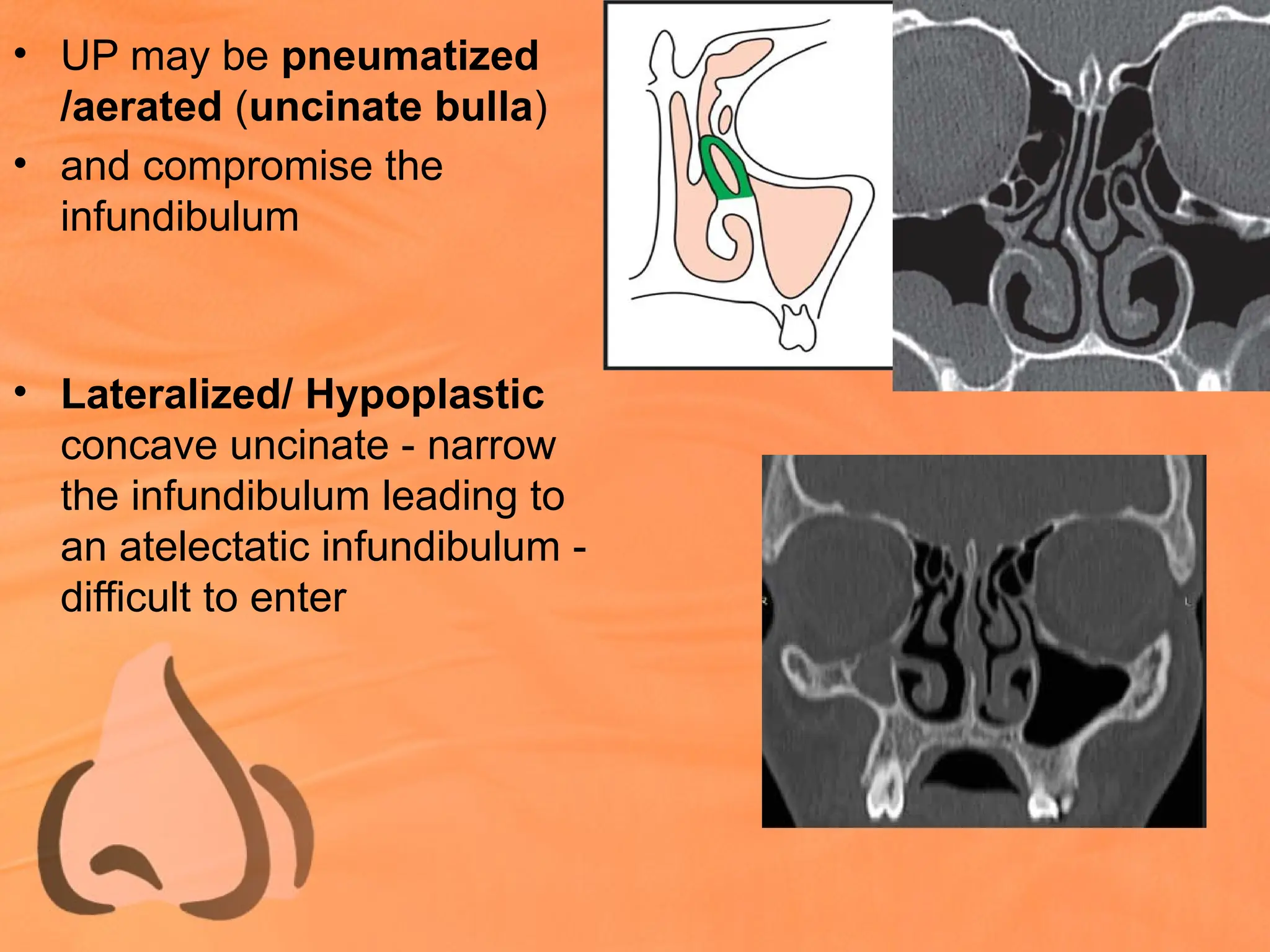 • UP may be pneumatized
/aerated (uncinate bulla)
• and compromise the
infundibulum
• Lateralized/ Hypoplastic
concave uncinate - narrow
the infundibulum leading to
an atelectatic infundibulum -
difficult to enter
 