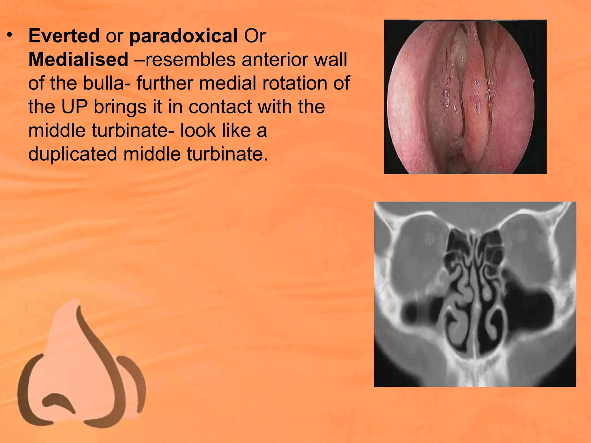 • Everted or paradoxical Or
Medialised –resembles anterior wall
of the bulla- further medial rotation of
the UP brings it in contact with the
middle turbinate- look like a
duplicated middle turbinate.
 