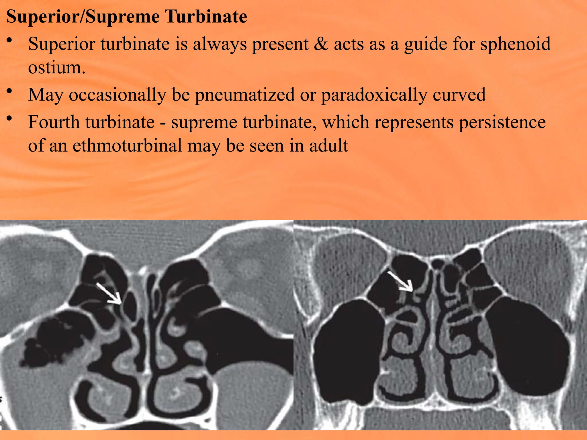 Superior/Supreme Turbinate
• Superior turbinate is always present & acts as a guide for sphenoid
ostium.
• May occasionally be pneumatized or paradoxically curved
• Fourth turbinate - supreme turbinate, which represents persistence
of an ethmoturbinal may be seen in adult
 