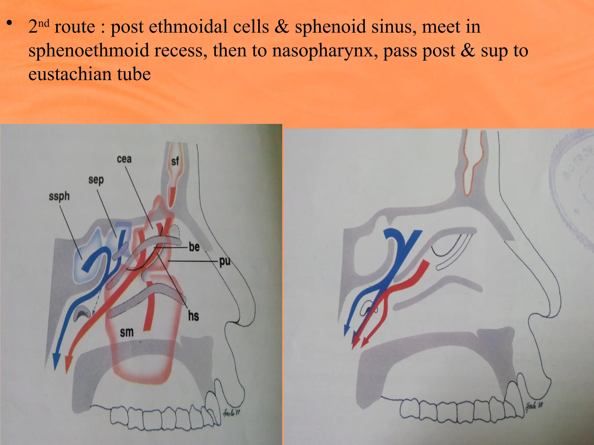 • 2nd
route : post ethmoidal cells & sphenoid sinus, meet in
sphenoethmoid recess, then to nasopharynx, pass post & sup to
eustachian tube
 