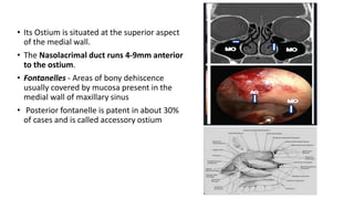 Accessory Ostium ANATOMY OF NOSE AND PARANASAL SINUSES.pptx