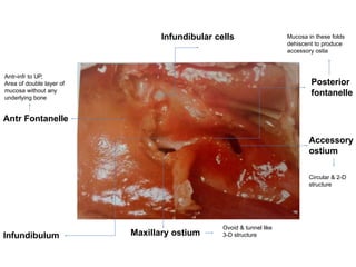 Accessory Ostium Comprehensive Anatomy and Development of Nose and Paranasal Sinuses | PPTX