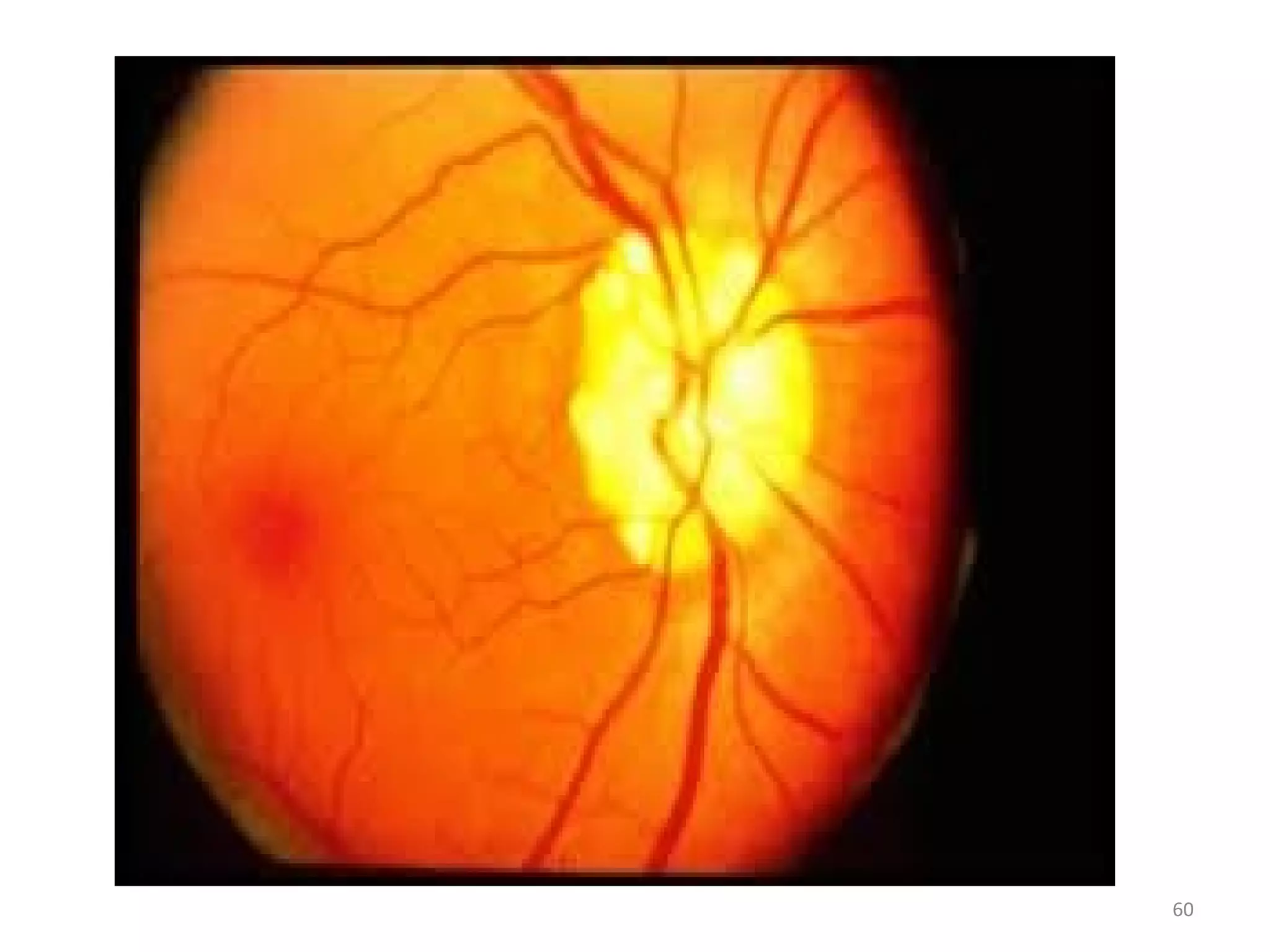 Dexoptic Anatomy Of Optic Nerve And Its Clinical Significance Anatomy Of Optic