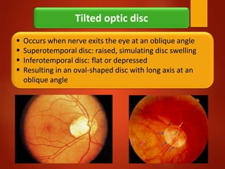 Anatomy of optic nerve (Optic Nerve Anatomy), Blood Supply & Clinical ...