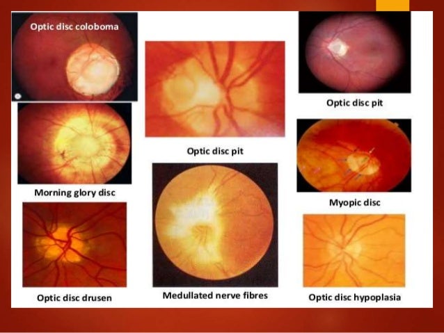 Optic Disc Halo Ring Optic Disc Halo Ring