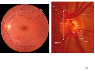 anatomy of optic nerve raju (1).pptx good | PPTX