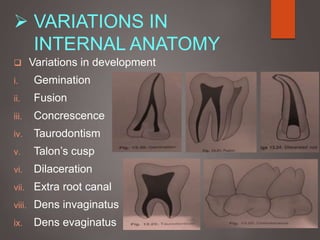  VARIATIONS IN
INTERNAL ANATOMY
 Variations in development
i. Gemination
ii. Fusion
iii. Concrescence
iv. Taurodontism
v. Talon’s cusp
vi. Dilaceration
vii. Extra root canal
viii. Dens invaginatus
ix. Dens evaginatus
 