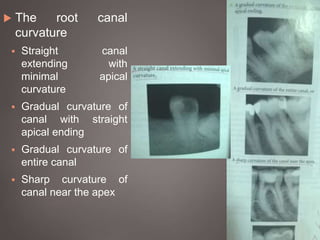  The root canal
curvature
 Straight canal
extending with
minimal apical
curvature
 Gradual curvature of
canal with straight
apical ending
 Gradual curvature of
entire canal
 Sharp curvature of
canal near the apex
 