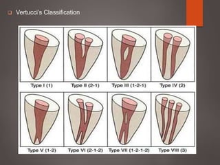  Vertucci’s Classification
 