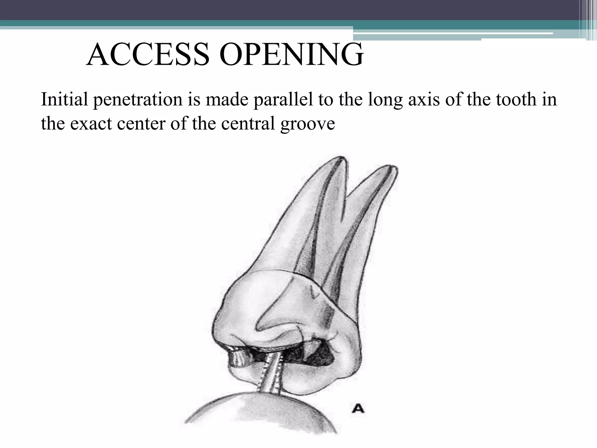 Anatomy of pulp canal and its access opening | PPTX