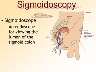 SigmoidoscopySigmoidoscopeAn endoscope for viewing the lumen of the sigmoid colon