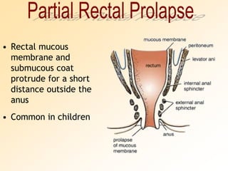 Partial Rectal ProlapseRectal mucous membrane and submucous coat protrude for a short distance outside the anusCommon in children