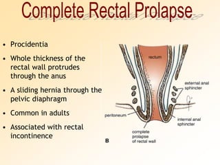 Complete Rectal ProlapseProcidentiaWhole thickness of the rectal wall protrudes through the anusA sliding hernia through the pelvic diaphragmCommon in adultsAssociated with rectal incontinence