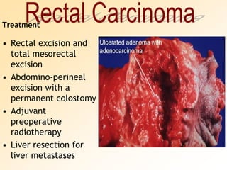 Rectal CarcinomaTreatmentRectal excision and total mesorectal excisionAbdomino-perineal excision with a permanent colostomyAdjuvant preoperative radiotherapyLiver resection for liver metastases 