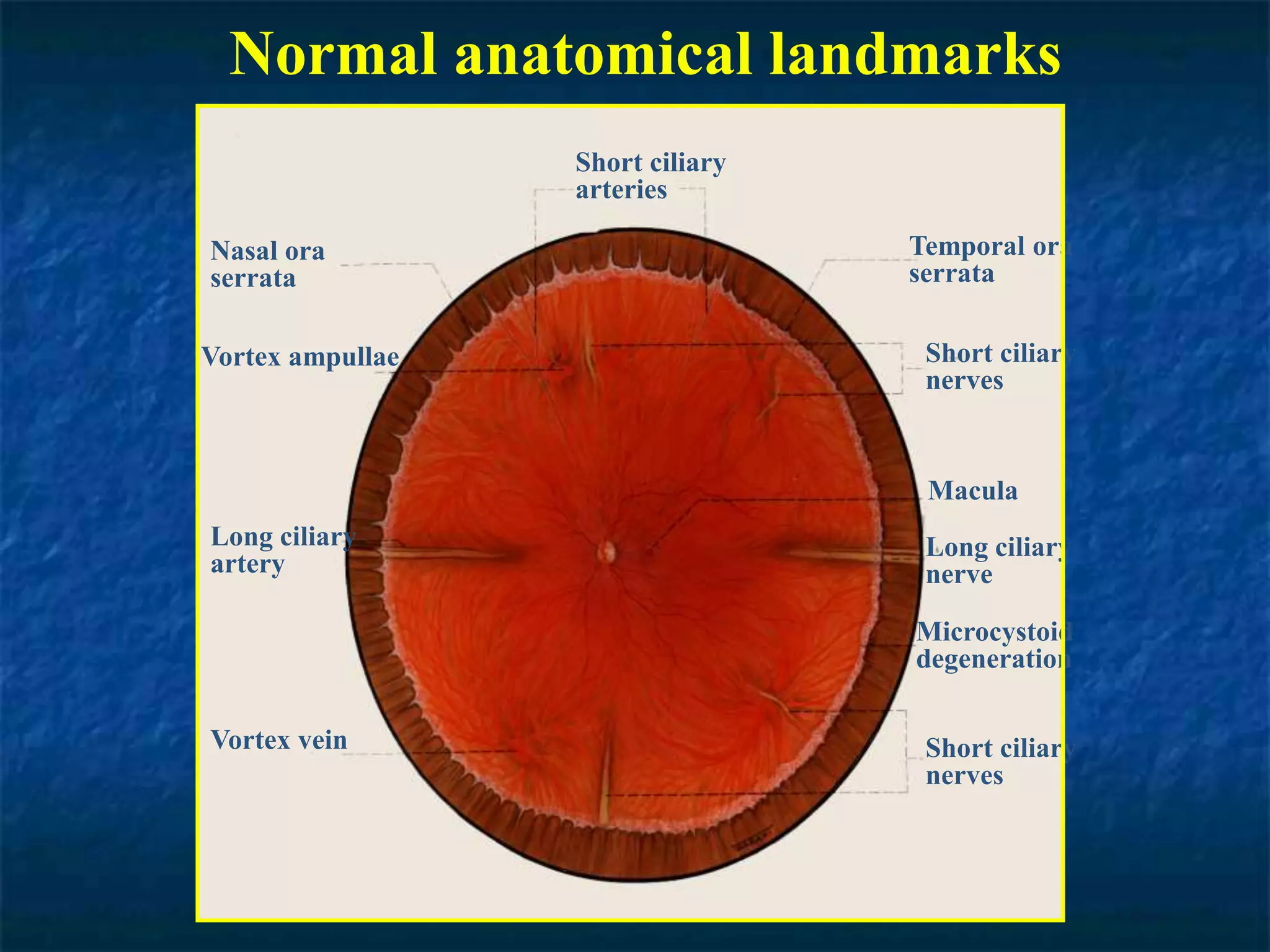 Normal anatomical landmarks
Short ciliary
arteries
Temporal ora
serrata
Short ciliary
nerves
Macula
Long ciliary
nerve
Short ciliary
nerves
Microcystoid
degeneration
Nasal ora
serrata
Vortex ampullae
Long ciliary
artery
Vortex vein
 