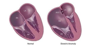 Anatomy of Right Atrium and Right Ventricle- Dr. Garv.pptx