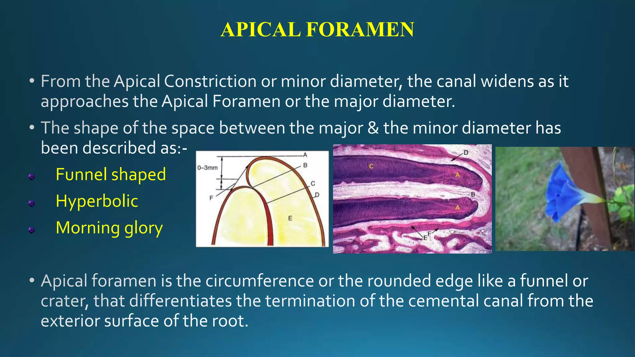 APICAL FORAMEN
Funnel shaped
Hyperbolic
Morning glory
 