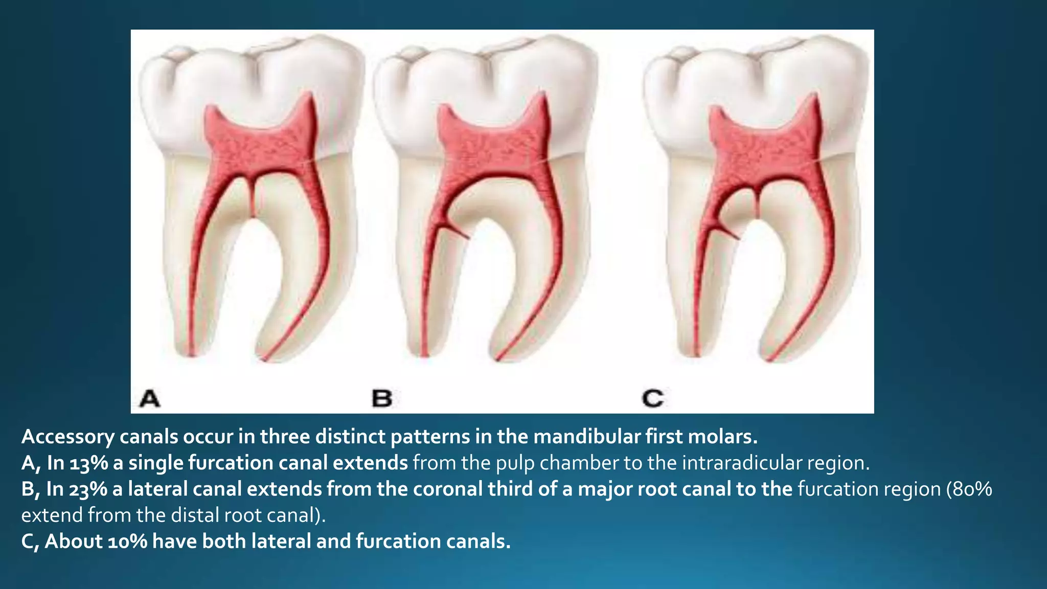 Accessory canals occur in three distinct patterns in the mandibular first molars.
A, In 13% a single furcation canal extends from the pulp chamber to the intraradicular region.
B, In 23% a lateral canal extends from the coronal third of a major root canal to the furcation region (80%
extend from the distal root canal).
C, About 10% have both lateral and furcation canals.
 