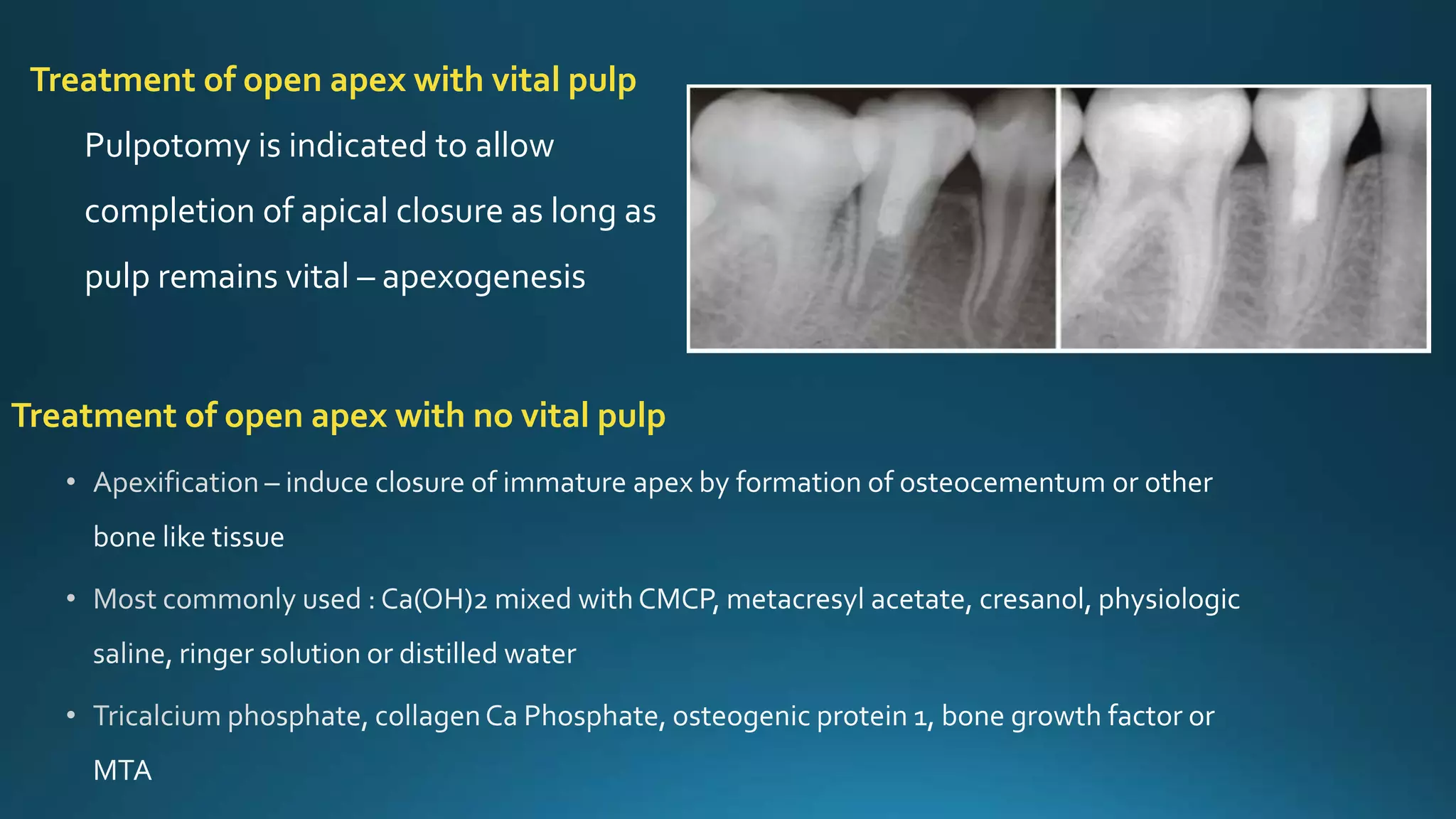 Treatment of open apex with no vital pulp
Treatment of open apex with vital pulp
Pulpotomy is indicated to allow
completion of apical closure as long as
pulp remains vital – apexogenesis
 