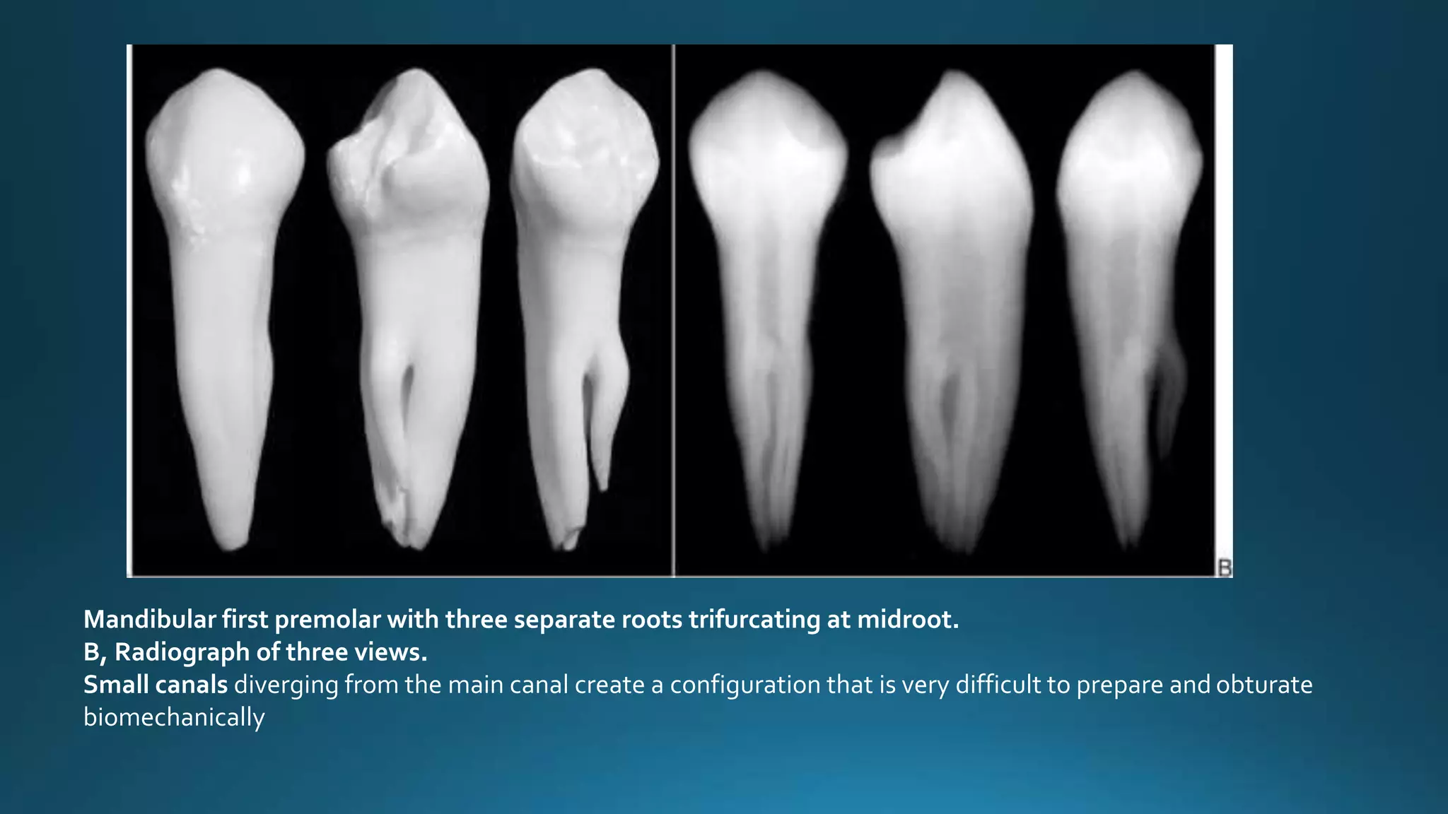 Mandibular first premolar with three separate roots trifurcating at midroot.
B, Radiograph of three views.
Small canals diverging from the main canal create a configuration that is very difficult to prepare and obturate
biomechanically
 