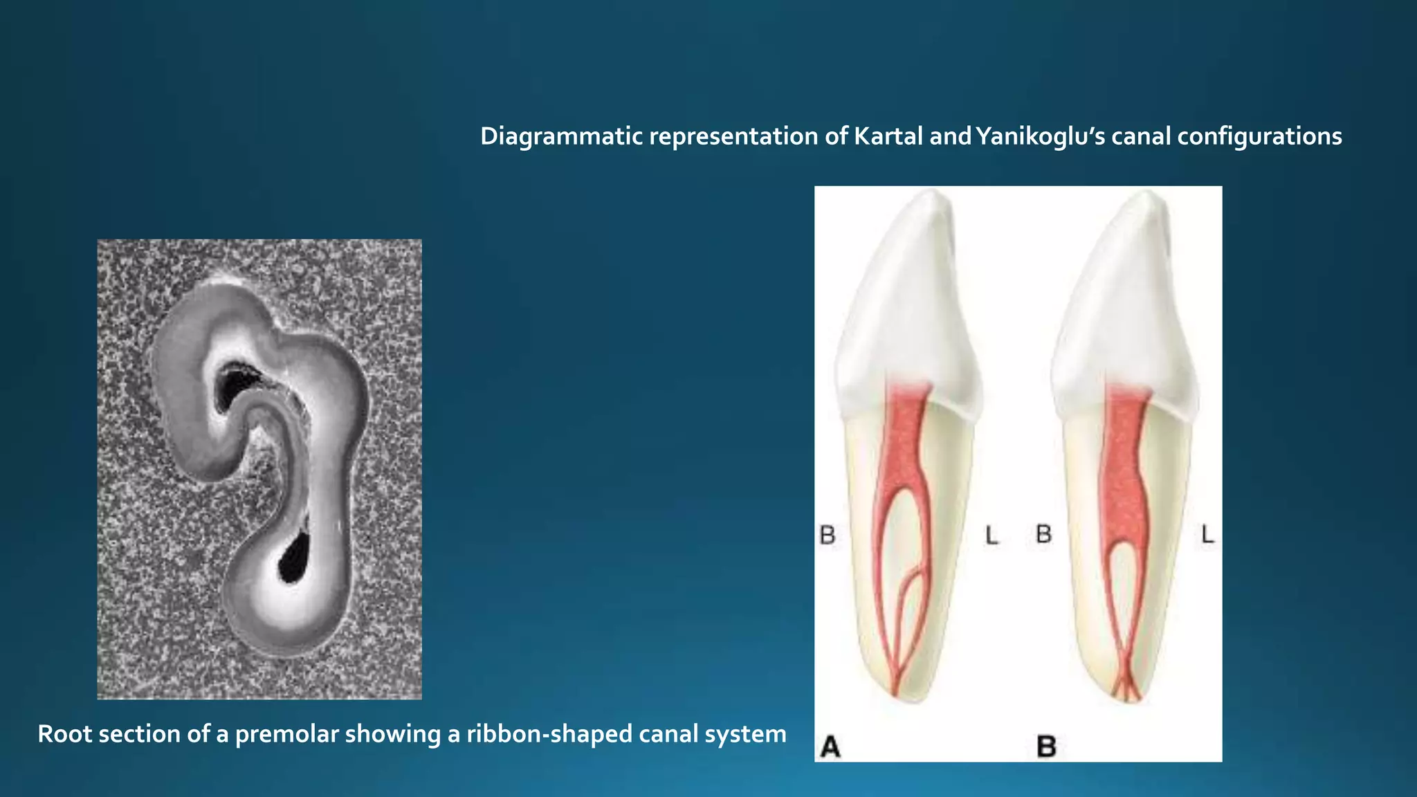 Root section of a premolar showing a ribbon-shaped canal system
Diagrammatic representation of Kartal andYanikoglu’s canal configurations
 