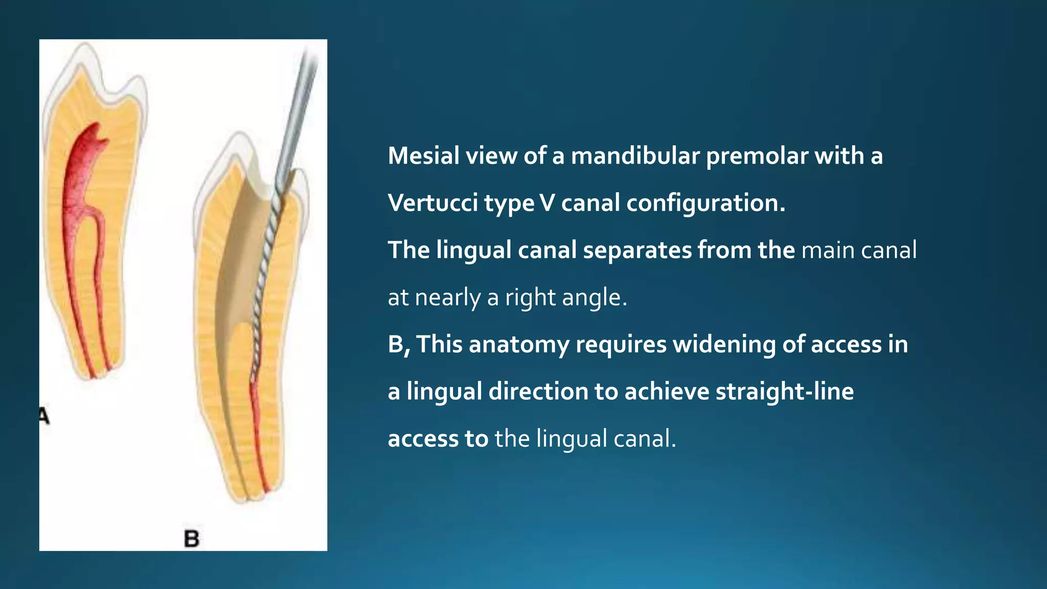 Mesial view of a mandibular premolar with a
Vertucci typeV canal configuration.
The lingual canal separates from the main canal
at nearly a right angle.
B,This anatomy requires widening of access in
a lingual direction to achieve straight-line
access to the lingual canal.
 