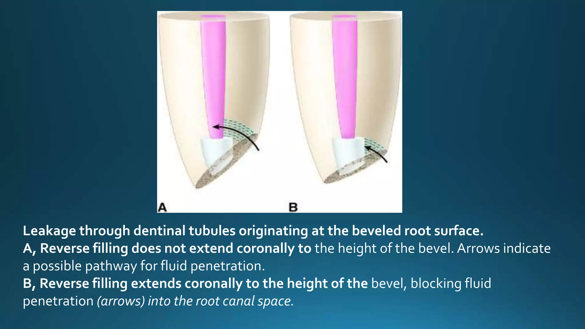 Leakage through dentinal tubules originating at the beveled root surface.
A, Reverse filling does not extend coronally to the height of the bevel. Arrows indicate
a possible pathway for fluid penetration.
B, Reverse filling extends coronally to the height of the bevel, blocking fluid
penetration (arrows) into the root canal space.
 