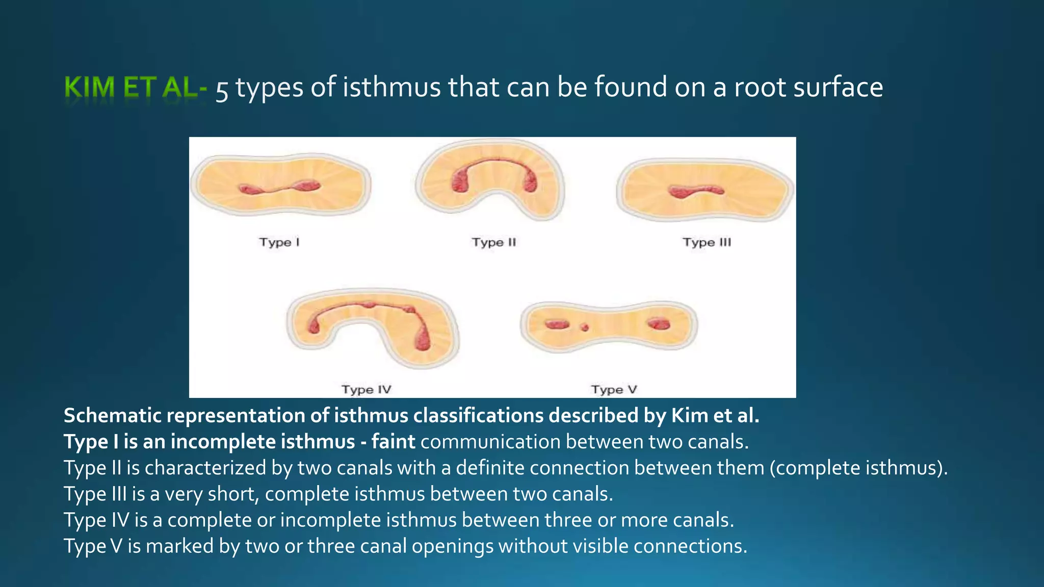 Schematic representation of isthmus classifications described by Kim et al.
Type I is an incomplete isthmus - faint communication between two canals.
Type II is characterized by two canals with a definite connection between them (complete isthmus).
Type III is a very short, complete isthmus between two canals.
Type IV is a complete or incomplete isthmus between three or more canals.
TypeV is marked by two or three canal openings without visible connections.
 