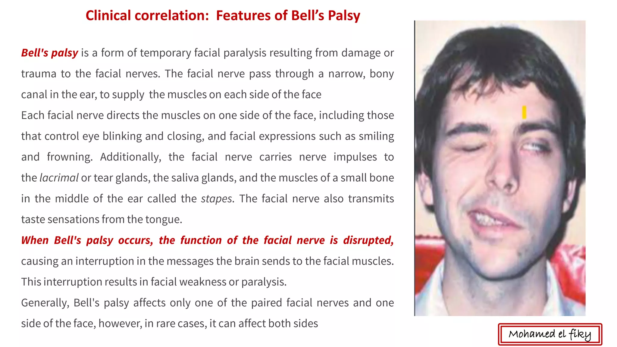 Clinical correlation: Features of Bell’s Palsy
Mohamed el fiky
 