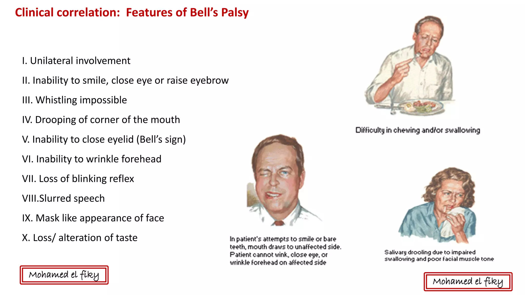 Clinical correlation: Features of Bell’s Palsy
I. Unilateral involvement
II. Inability to smile, close eye or raise eyebrow
III. Whistling impossible
IV. Drooping of corner of the mouth
V. Inability to close eyelid (Bell’s sign)
VI. Inability to wrinkle forehead
VII. Loss of blinking reflex
VIII.Slurred speech
IX. Mask like appearance of face
X. Loss/ alteration of taste
Mohamed el fiky
Mohamed el fiky
 