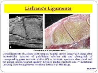 Dr M Eladl
Lisfranc’s Ligaments
Castro M et al. AJR 2010;195:W447-W455
Dorsal ligaments of Lisfranc joint complex. Sagittal proton density MR image after
intraarticular injection of gadolinium solution (B) and photograph of
corresponding gross anatomic section (C) in cadaveric specimen show short and
flat dorsal tarsometatarsal ligament between medial cuniform and 1st metatarsal
(arrows). Note homogeneous low signal intensity at MR image.
 