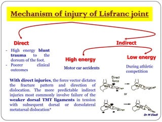 Dr M Eladl
Mechanism of injury of Lisfranc joint
Direct Indirect
- High energy blunt
trauma to the
dorsum of the foot.
- Poorer clinical
outcomes Motor car accidents
High energy Low energy
During athletic
competition
With direct injuries, the force vector dictates
the fracture pattern and direction of
dislocation. The more predictable indirect
injuries most commonly involve failure of the
weaker dorsal TMT ligaments in tension
with subsequent dorsal or dorsolateral
metatarsal dislocation*
 