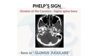 ANATOMY OF TEMPORAL BONE AND CLINICAL IMPORTANCE.pptx