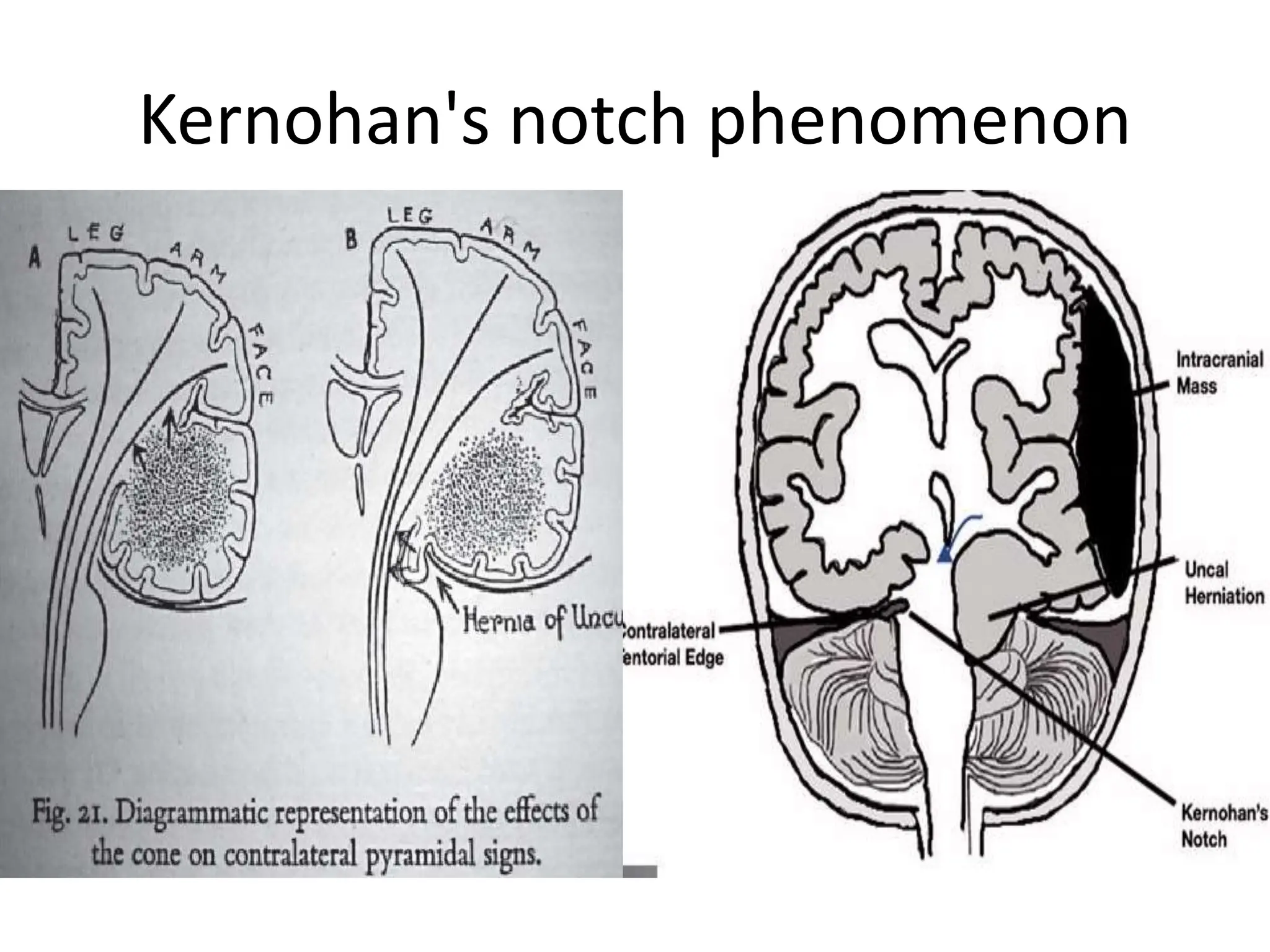 ANATOMY OF TENTORIUM INCISURA | PPTX