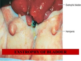 EXSTROPHY OF BLADDER
 