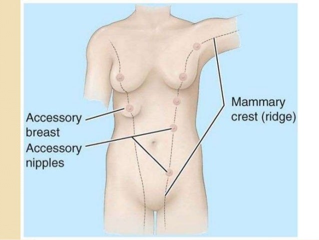 Extra (supernumerary or accessory) nipples or breast tissue 