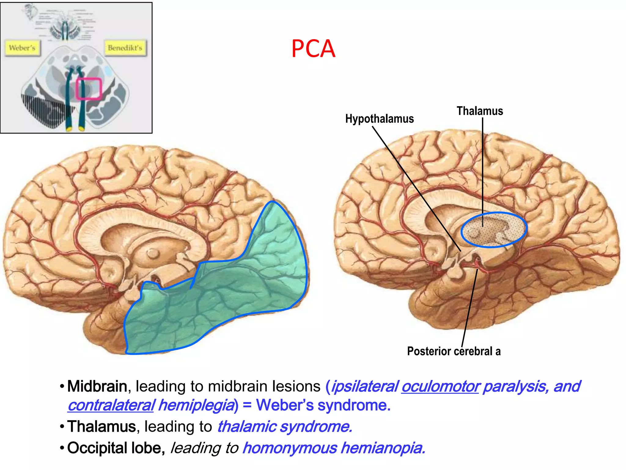 PCA
Hypothalamus
Thalamus
Posterior cerebral a
• Midbrain, leading to midbrain lesions (ipsilateral oculomotor paralysis, and
contralateral hemiplegia) = Weber’s syndrome.
• Thalamus, leading to thalamic syndrome.
• Occipital lobe, leading to homonymous hemianopia.