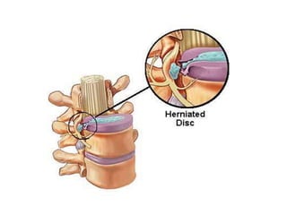 Disc Muscles Anatomy of the Disc | PPT