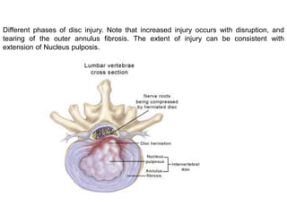 Disc In Human Body anatomy of the disc in spine anatomy complete | PPT