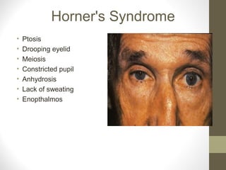 Horner's Syndrome
• Ptosis
• Drooping eyelid
• Meiosis
• Constricted pupil
• Anhydrosis
• Lack of sweating
• Enopthalmos
 