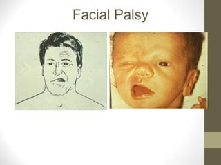 Facial Palsy
 
