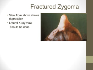 Fractured Zygoma
• View from above shows
depression
• Lateral X-ray view
should be done
 