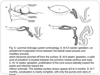 Fig. 6. Lacrimal drainage system embryology. A. At 5.5 weeks' gestation, an
ectodermal invagination forms between the lateral nasal process and
maxillary process,
which becomes pinched off from the surface. B. At 6 weeks' gestation, a solid
cord of ectoderm is located between the primitive medial canthus and nose.
C. At 12 weeks' gestation, proliferation of the cord occurs laterally toward the
eyelid and inferiorly toward the
inferior turbinate. The isolated cavities shown appear at3 to 4 months. D. At 7
months, canalization is nearly complete, with only the puncta and valve of
 