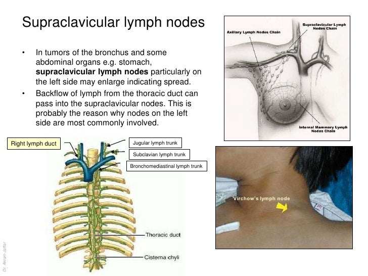 Swollen Supraclavicular Lymph Nodes Swollen Supraclavicular Lymph Nodes
